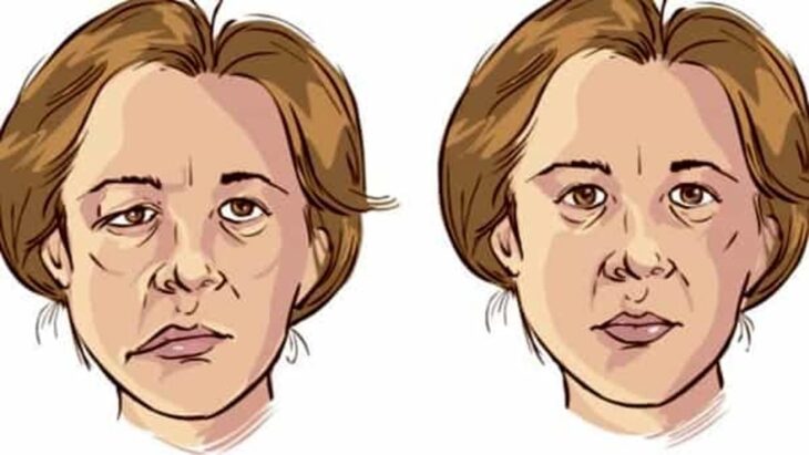 Non rimettiamoci la faccia: ben quattro sono gli effetti avversi a carico dei muscoli facciali dei vaccini Pfizer